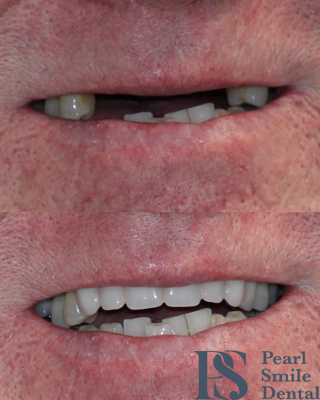 Pearl Smile Bromley Cross | Dentures Pearl Smile Bromley Cross | Dentures