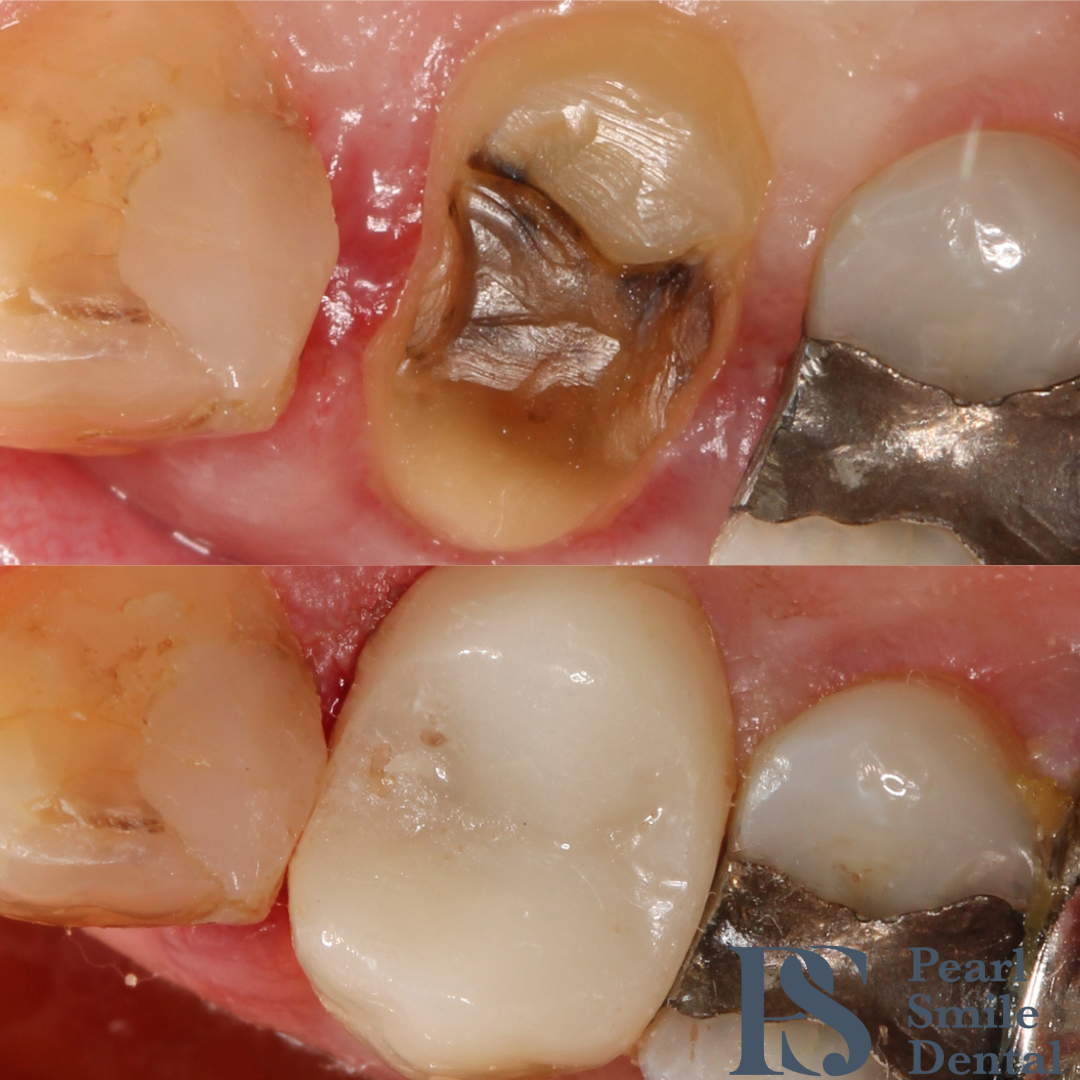 Pearl Smile Bromley Cross | Dental Crowns Pearl Smile Bromley Cross | Dental Crowns